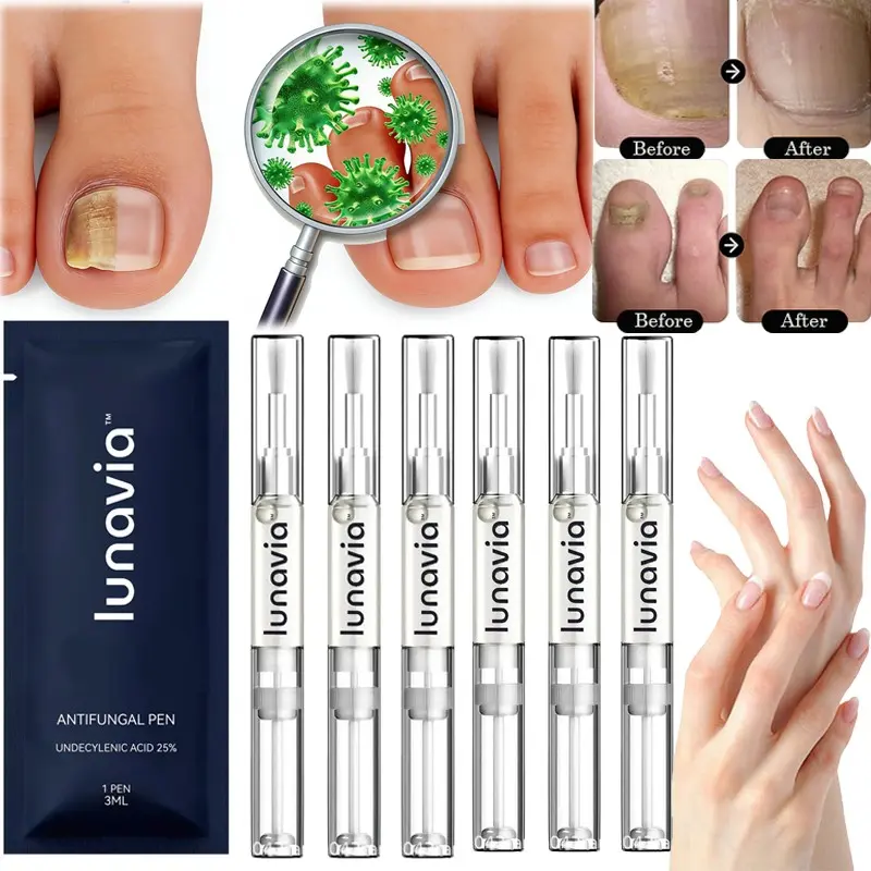 2PCS Lunavia Antifungal Pen with 25% Undecylenic Acid, Effective Toenail Fungus Treatment for Nail Care