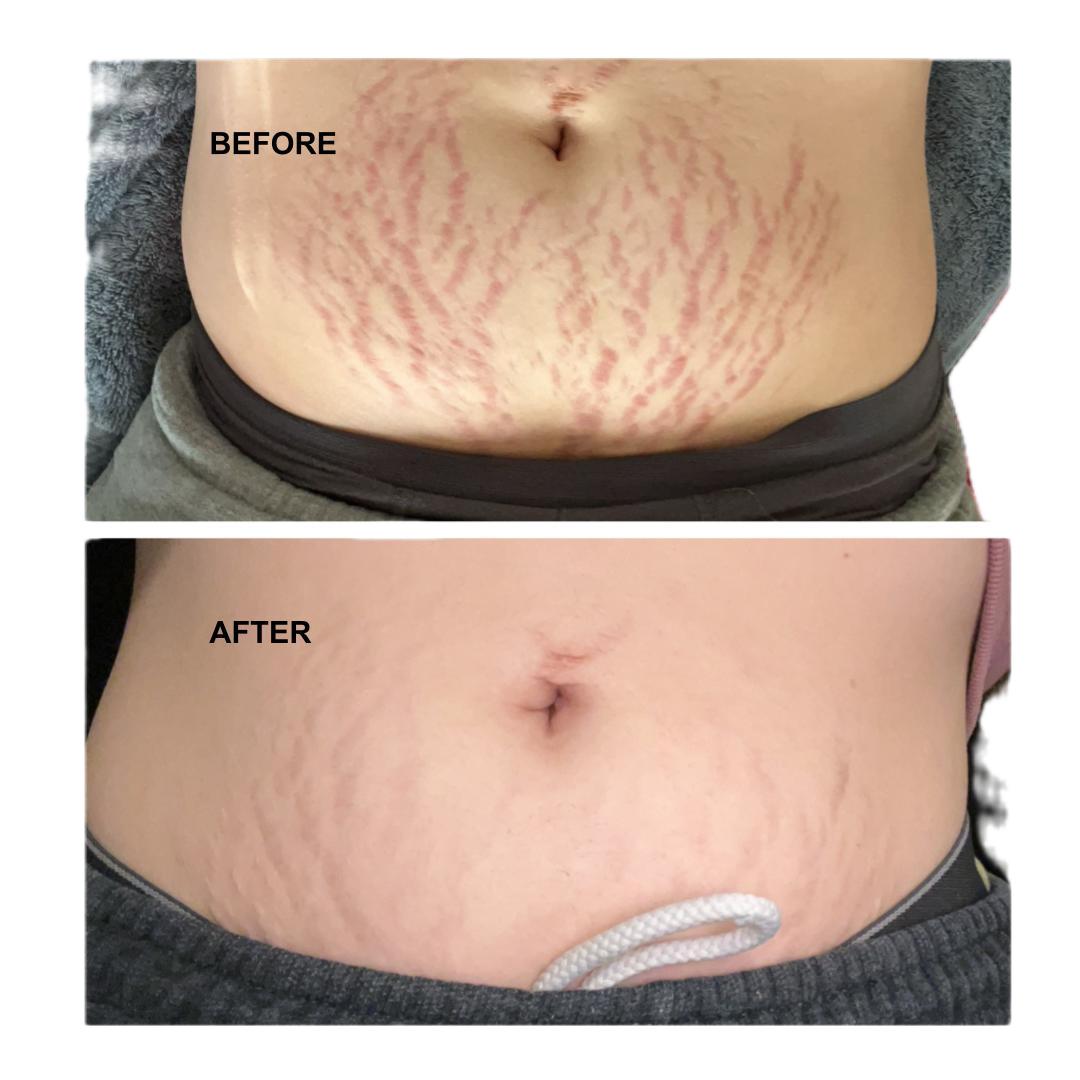 8 Sheep Organics True Belly Serum – Organic Stretch Mark Prevention & Pregnancy Belly Oil | Skincare, Mosturize, Skin Repair 8 Sheep Organics True Belly Serum – Organic Stretch Mark Prevention & Pregnancy Belly Oil | Skincare, Mosturize, Skin Repair