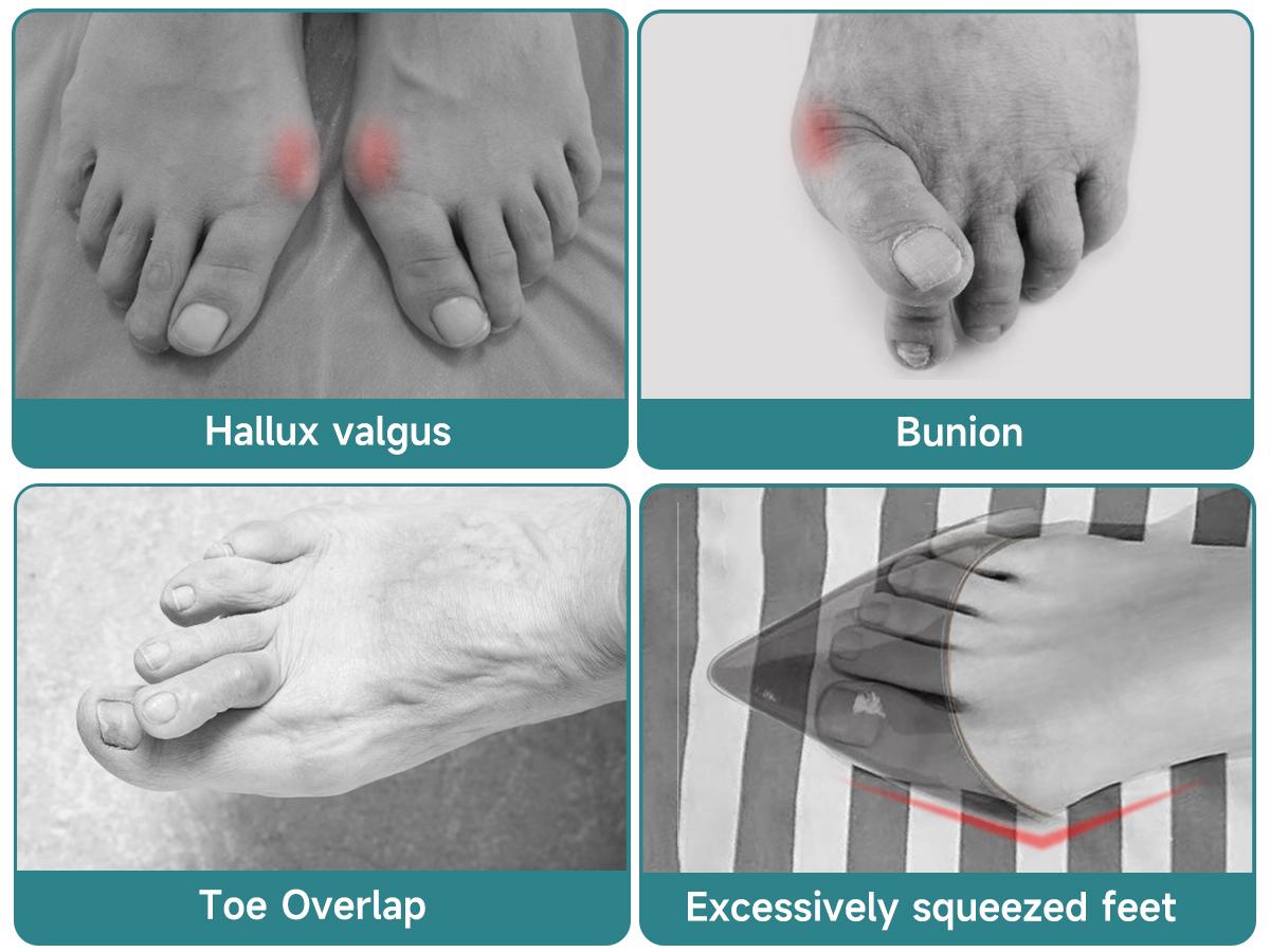 Bunion Corrector for Women Men Big Toe: Auto-Adaptive Bunion Relief for Big Toe Straightener - Orthopedic Bunion Splint for Pain Relief - Hallux Valgus Correction for Day/Night Support
