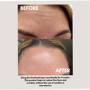 Forehead Tape – Wrinkle Smoothing Patches