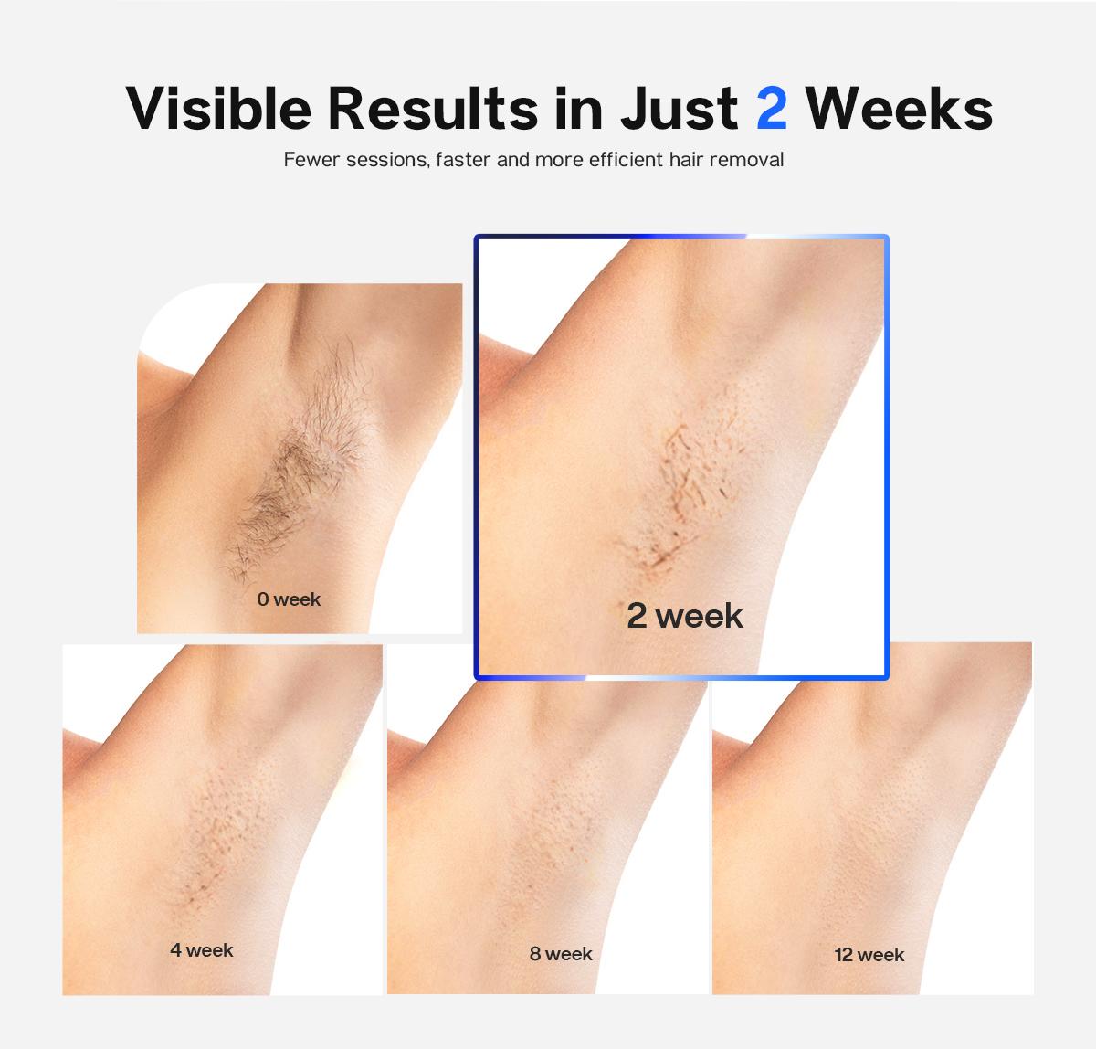 Blex Laser Hair Removal for Women and Men, Blex Velvet IPL Hair Removal Device with Sapphire Ice-Cooling Design, Dual-Pulse Technology & 0.2 Seconds Flash Gap, Nearly Painless & Lasting Result for Body & Face