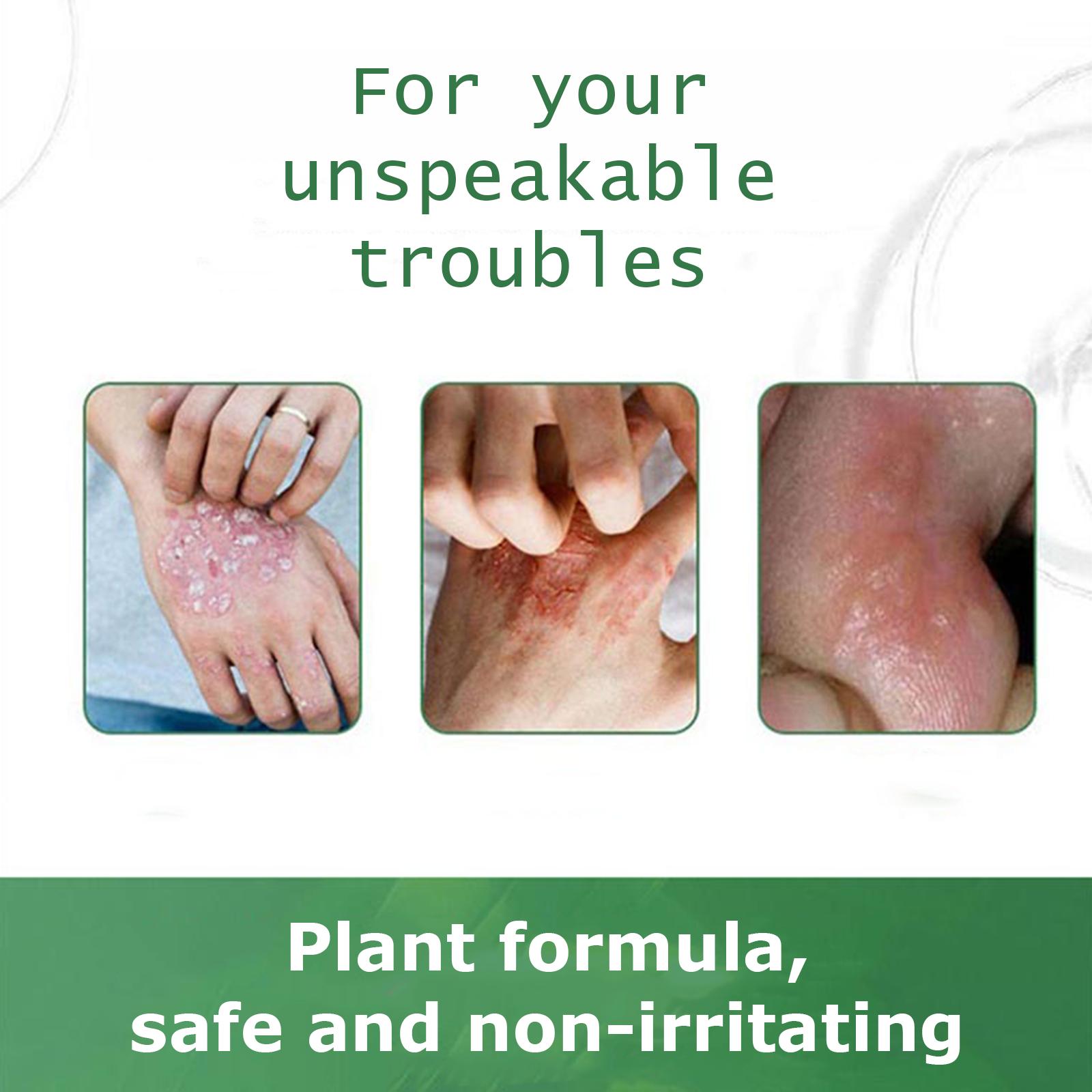 SanNuo Sensitive Skin Relief Cream– Fast Relief from Eczema, Blisters & Dry Itchy Skin with Oatmeal-Style Soothing, Zero-Irritant, Fragrance-Free – 30 g SanNuo Sensitive Skin Relief Cream– Fast Relief from Eczema, Blisters & Dry Itchy Skin with Oatmeal-Style Soothing, Zero-Irritant, Fragrance-Free – 30 g